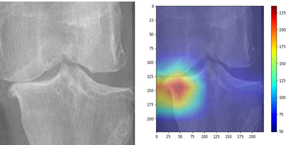 IIT Guwahati’s AI model to predict knee osteoarthritis severity from X-rays iit-guwahati’s-ai-model-to-predict-knee-osteoarthritis-severity-from-x-rays