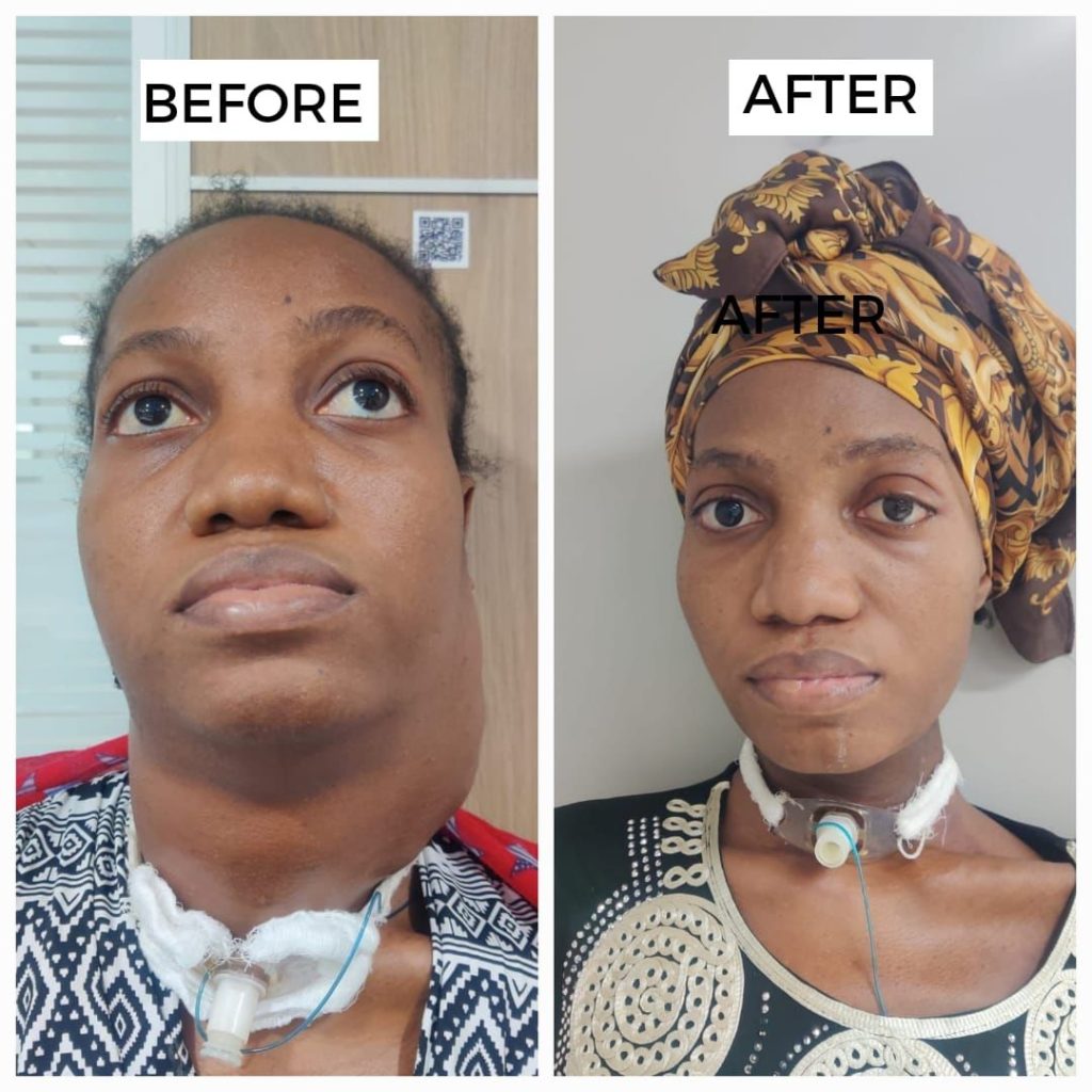 doctors-remove-musk-melon-sized-tumour-from-nigerian-woman’s-neck