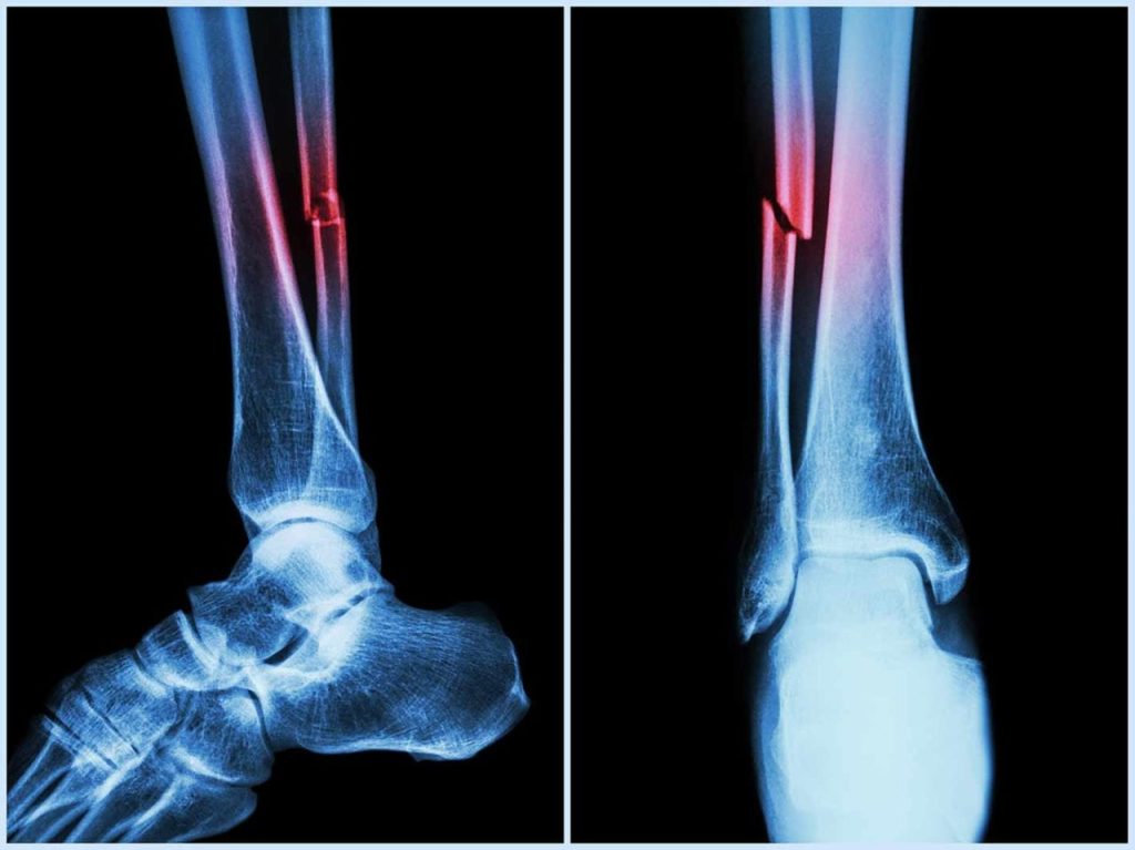 covid-can-cause-bone-loss,-higher-fracture-risk:-study