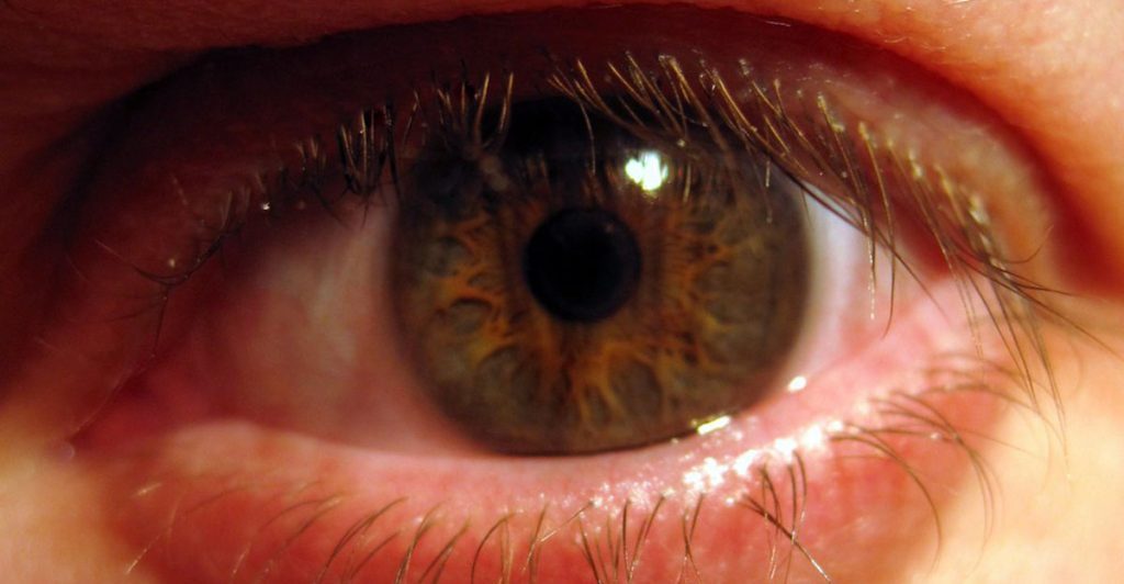 Delhi sees record rise in pink eye, dengue cases, say doctors delhi-sees-record-rise-in-pink-eye,-dengue-cases,-say-doctors