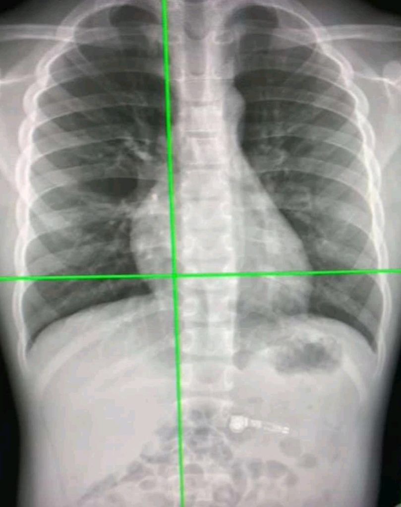 ai-powered-x-rays-can-tell-true-age-by-looking-at-chest