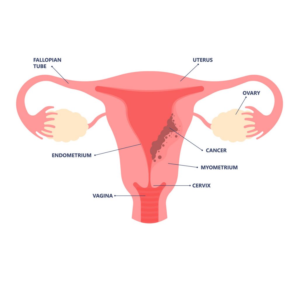 Testosterone shows promise to treat endometrial cancer: Study testosterone-shows-promise-to-treat-endometrial-cancer:-study