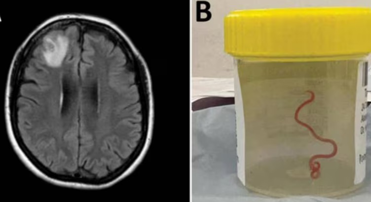 8-cm live worm removed from woman’s brain in world’s 1st discovery 8-cm-live-worm-removed-from-woman’s-brain-in-world’s-1st-discovery
