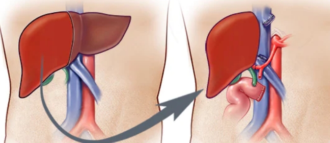 59-yr-old gets new life with liver transplant from a brain-dead donor 59-yr-old-gets-new-life-with-liver-transplant-from-a-brain-dead-donor