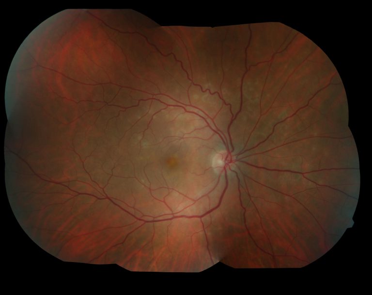 1st case of white dot syndrome post Covid vax & subsequent infection: Study 1st-case-of-white-dot-syndrome-post-covid-vax-&-subsequent-infection:-study