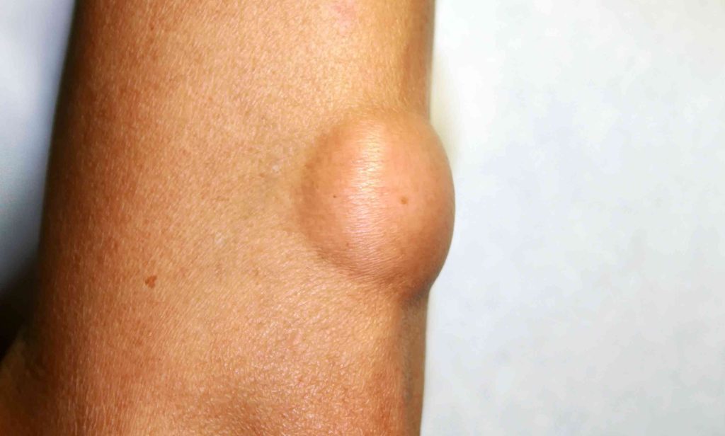 Don’t ignore painless lumps in body: experts don’t-ignore-painless-lumps-in-body:-experts