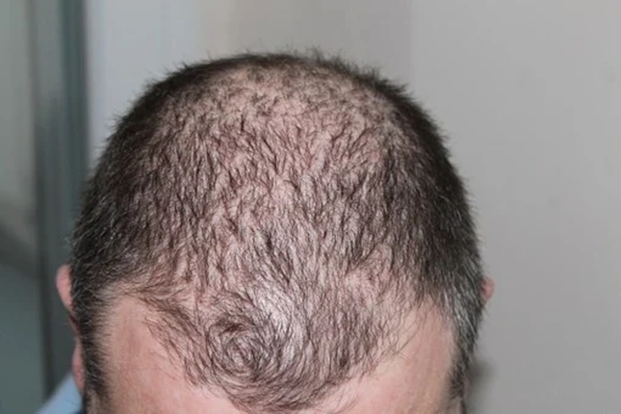 Rare gene variants causing hereditary hair loss in men identified rare-gene-variants-causing-hereditary-hair-loss-in-men-identified