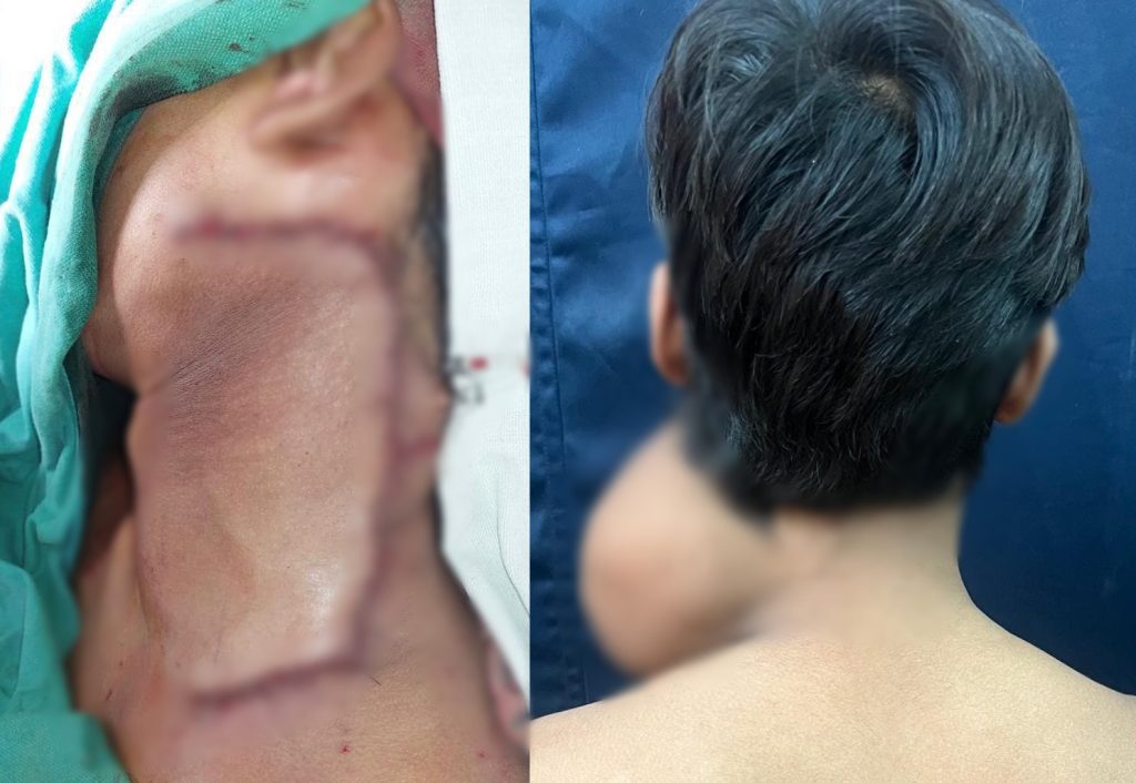 BMC hospital removes 2.5 kg tumour from teen’s neck after 7 hr surgery bmc-hospital-removes-2.5-kg-tumour-from-teen’s-neck-after-7-hr-surgery