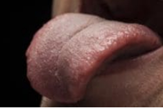 Delhi doctors remove tumour made up of blood vessels from man’s tongue delhi-doctors-remove-tumour-made-up-of-blood-vessels-from-man’s-tongue