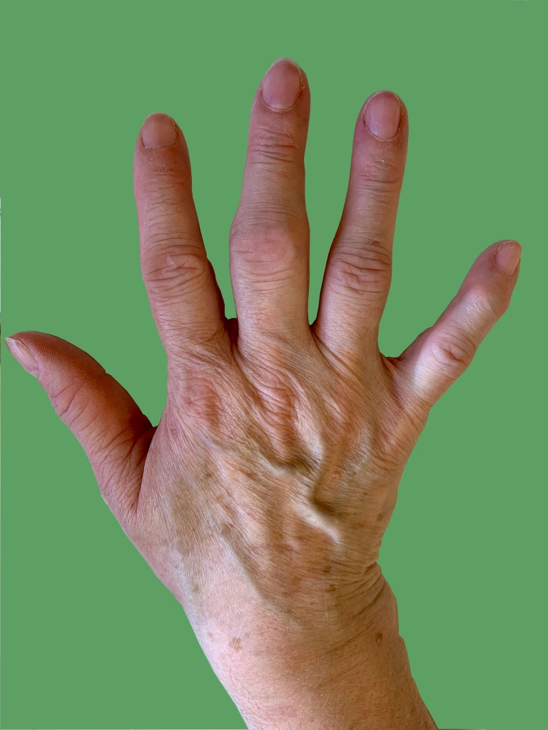 study-shows-common-drug-can-improve-hand-osteoarthritis-symptoms